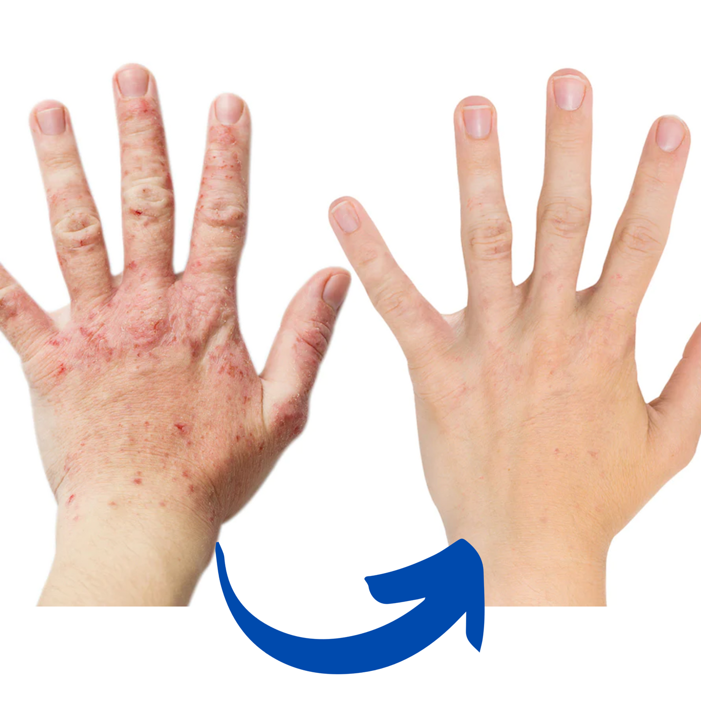 Infrarood handtherapiehandschoen – pijnverlichting en ondersteuning van gewrichten